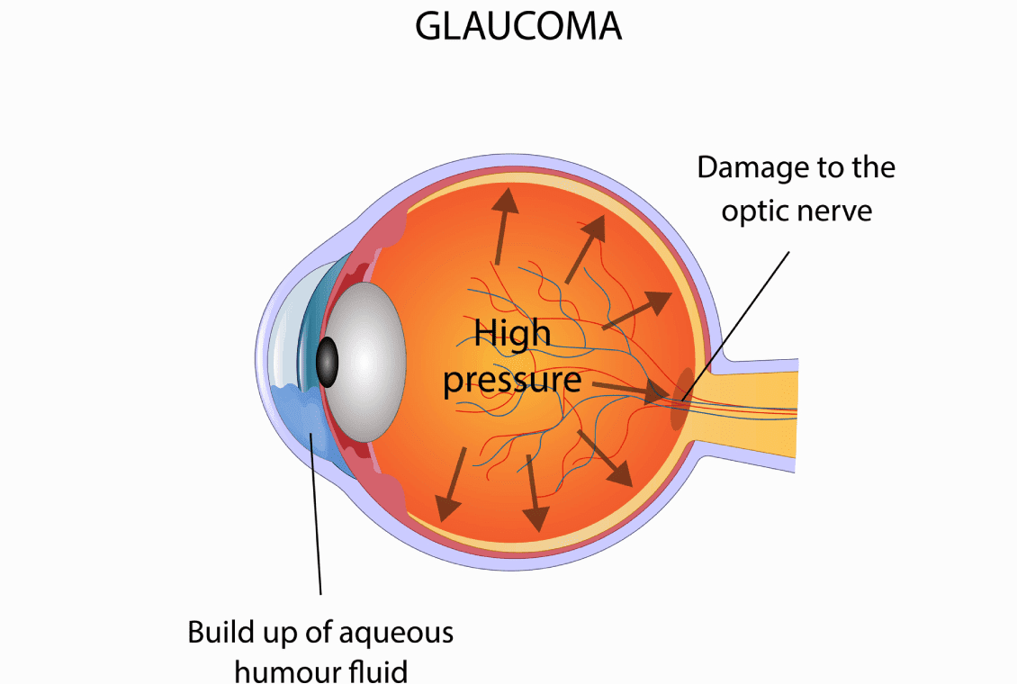 Diagram illustrating glaucoma's effect on the eye.