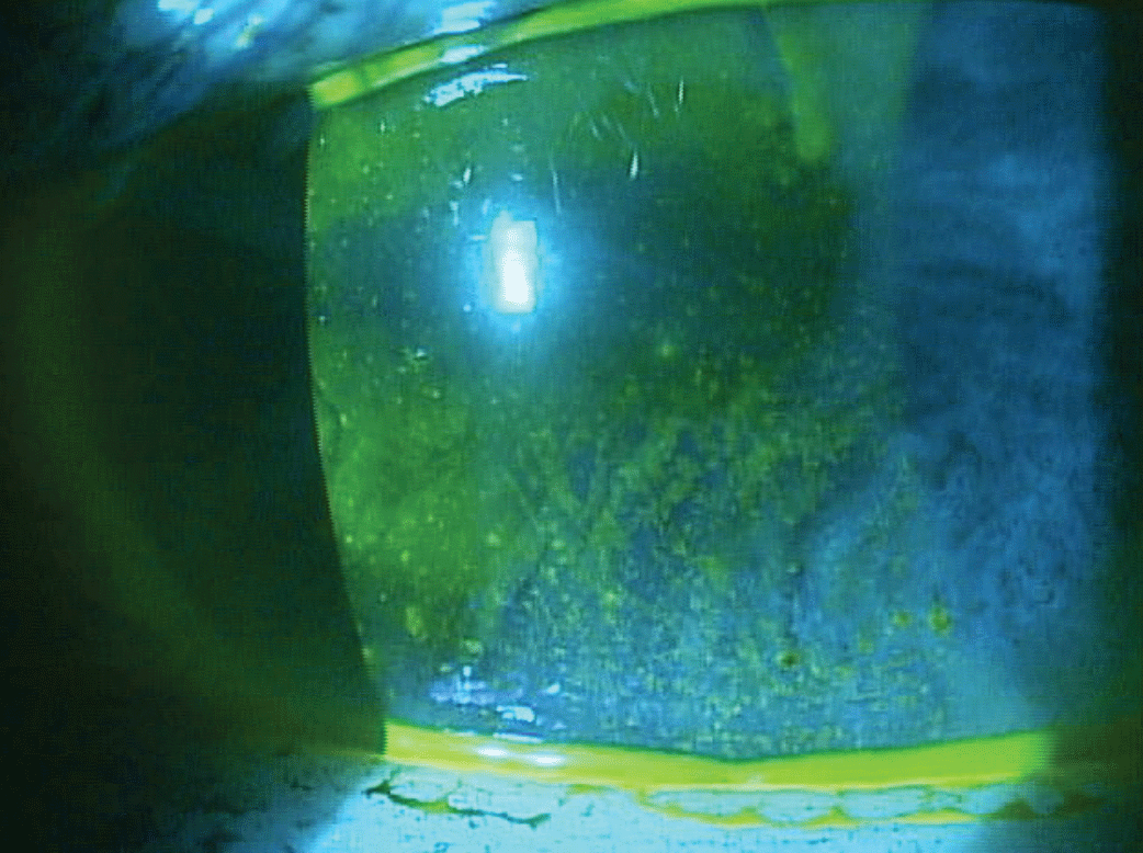 A glowing blue light illuminates a translucent greenish-yellow surface.